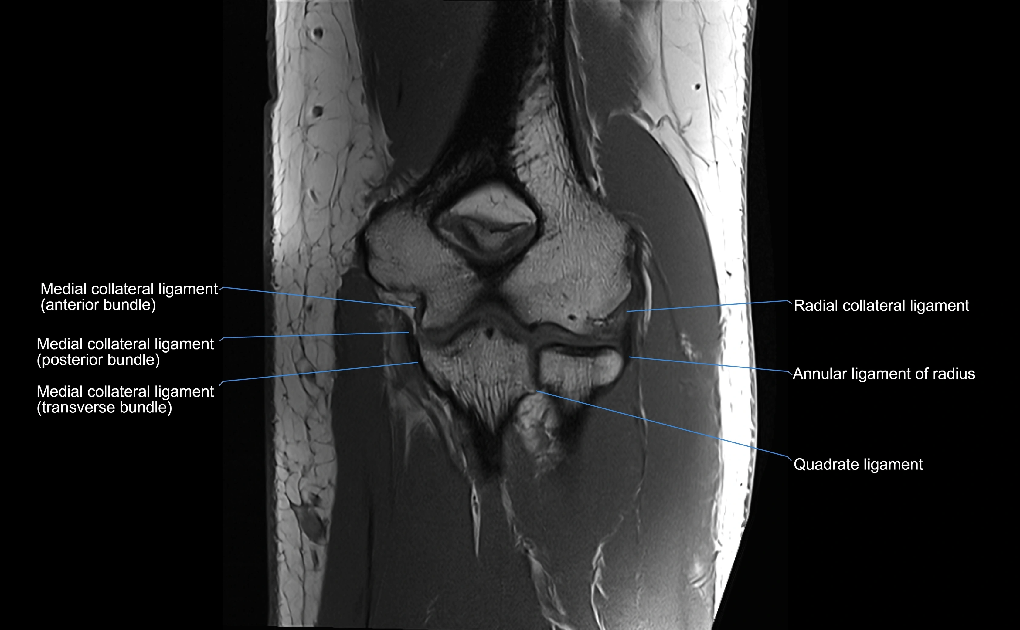 MRI elbow ligaments coronal cross sectional anatomy 3T  radiology  image-img-07001-00022.webp